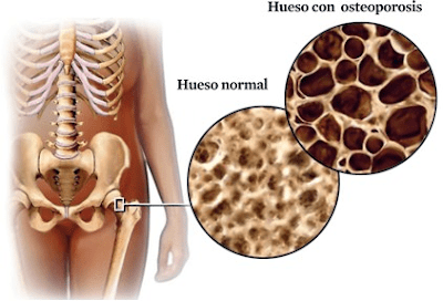 Osteoporosis: hábitos de vida y alimentación